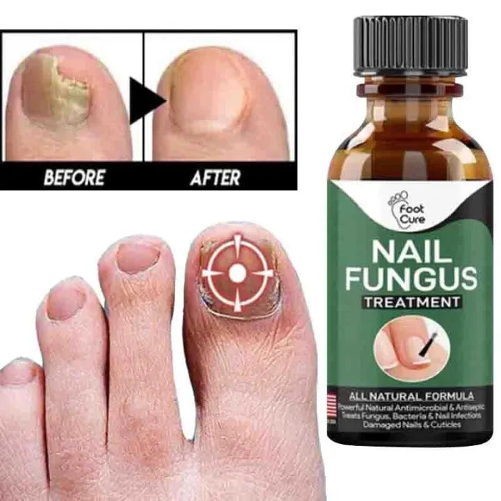 Nail Fungus Treatment Stop Fungal Growth Effective Fingernail 10ml